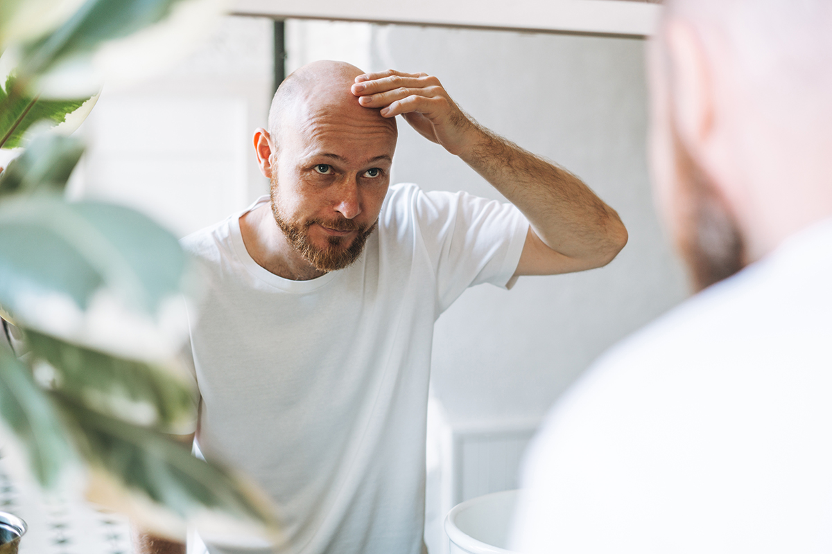 doctor, alopecia, injerto, cabello, calvicie, salud, cirugÃa